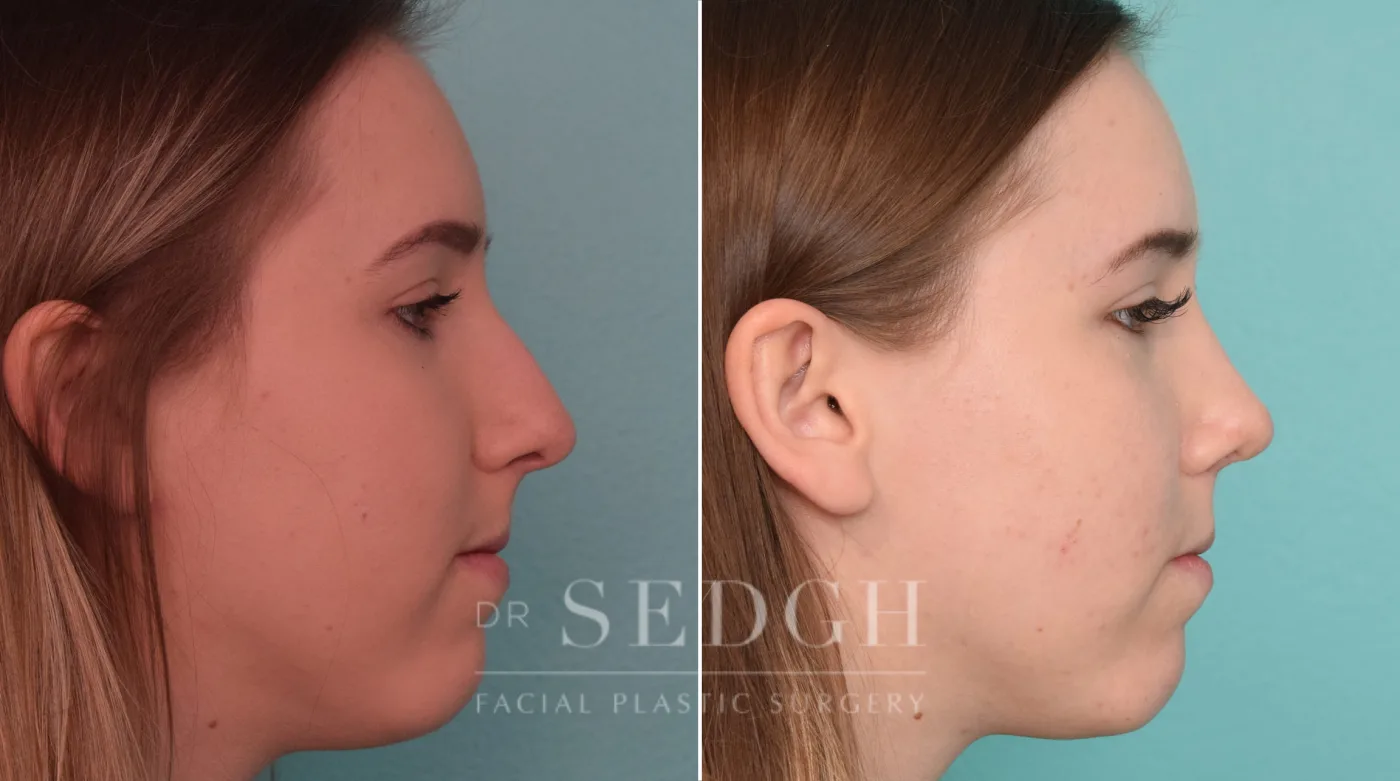 Patient 226 after Facial Fillers, view 2