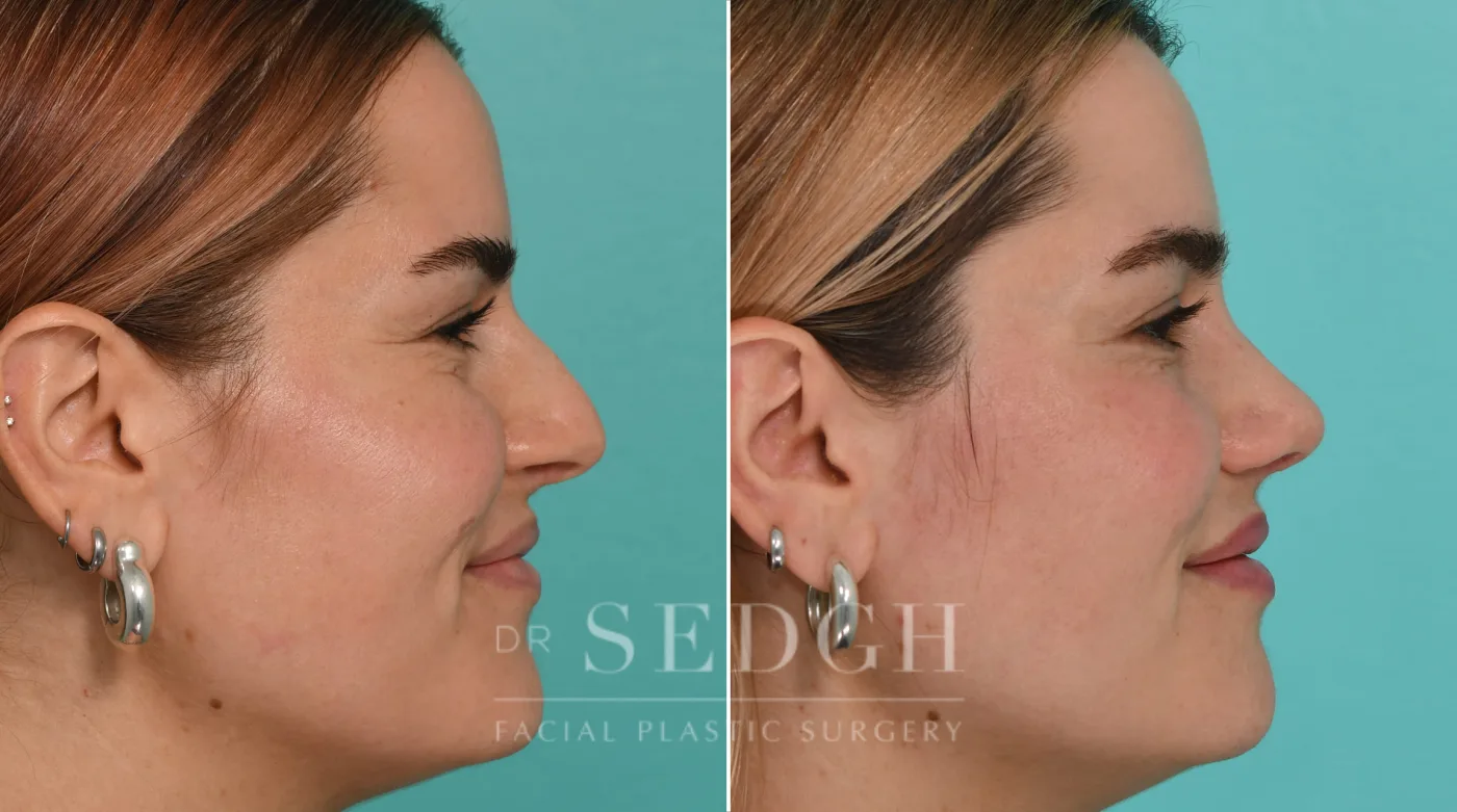 Patient 327 after Rhinoplasty, view 2