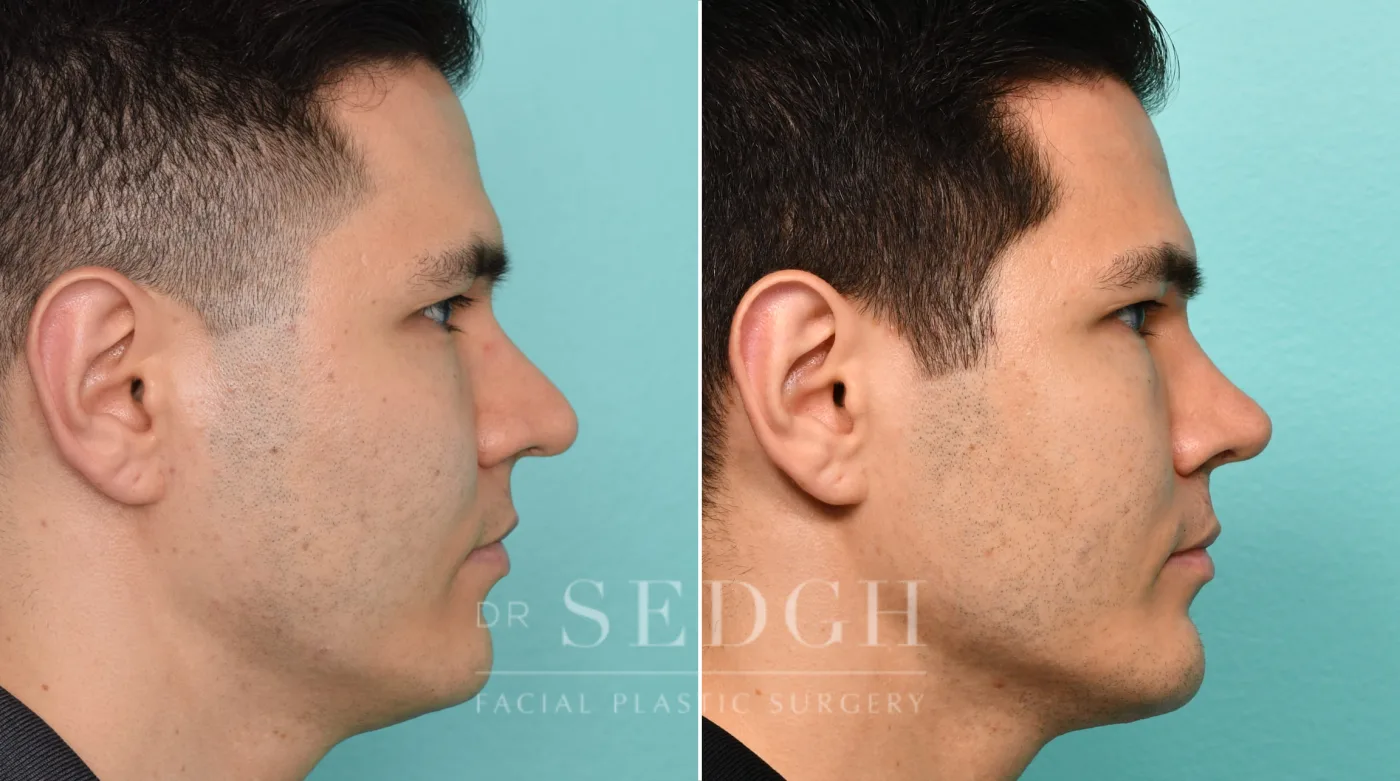 Patient 306 after Chin Augmentation, view 1