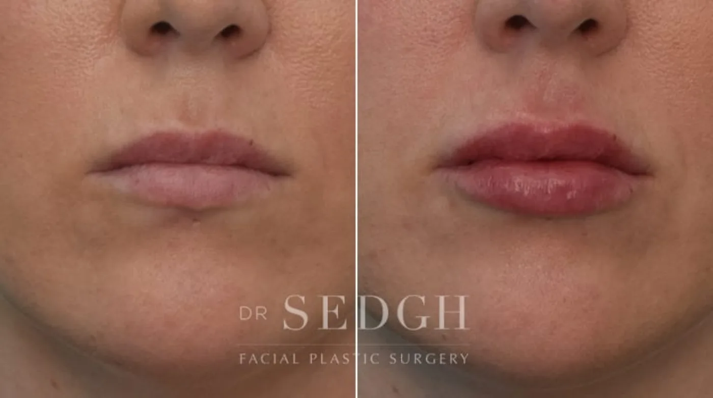 Patient 6 after lip augmentation, view 1