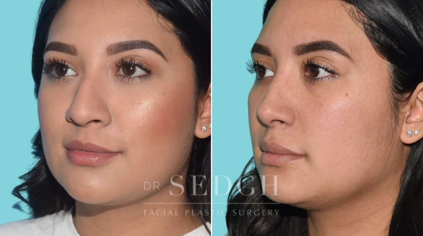 Patient 34 before Rhinoplasty, view 1