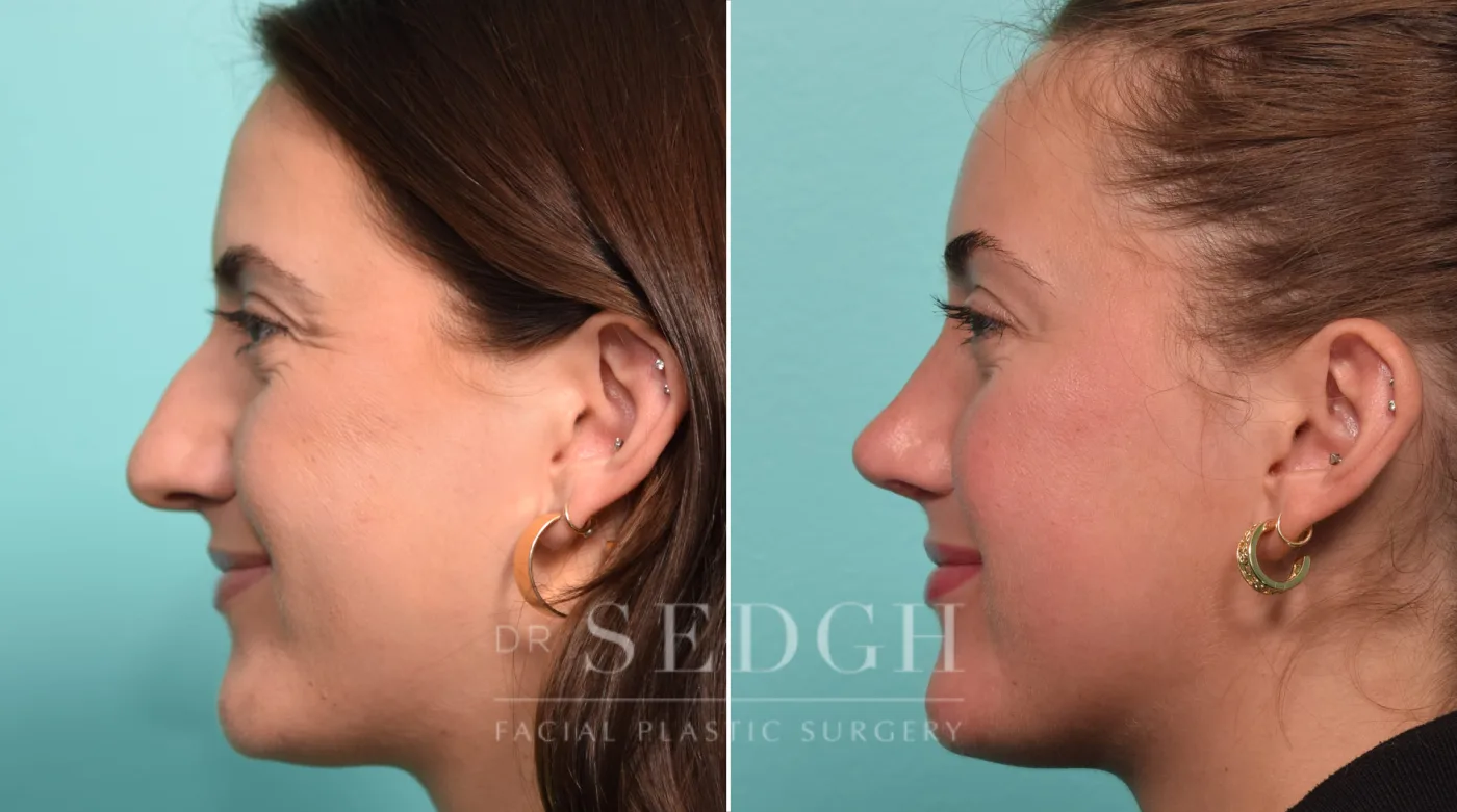 Patient 297 after Rhinoplasty, view 2