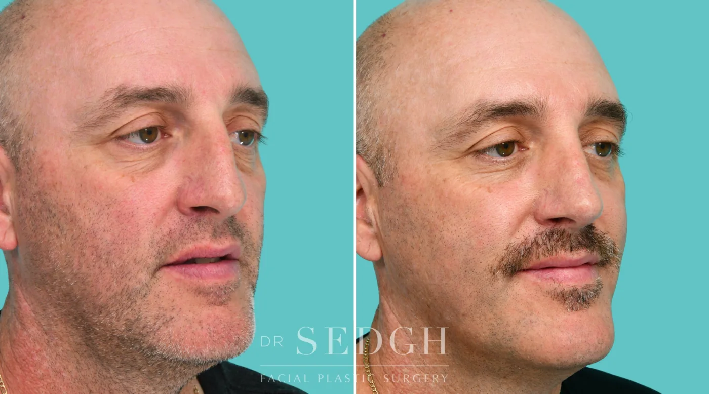 Patient 343 after Crooked Nose Surgery, view 2