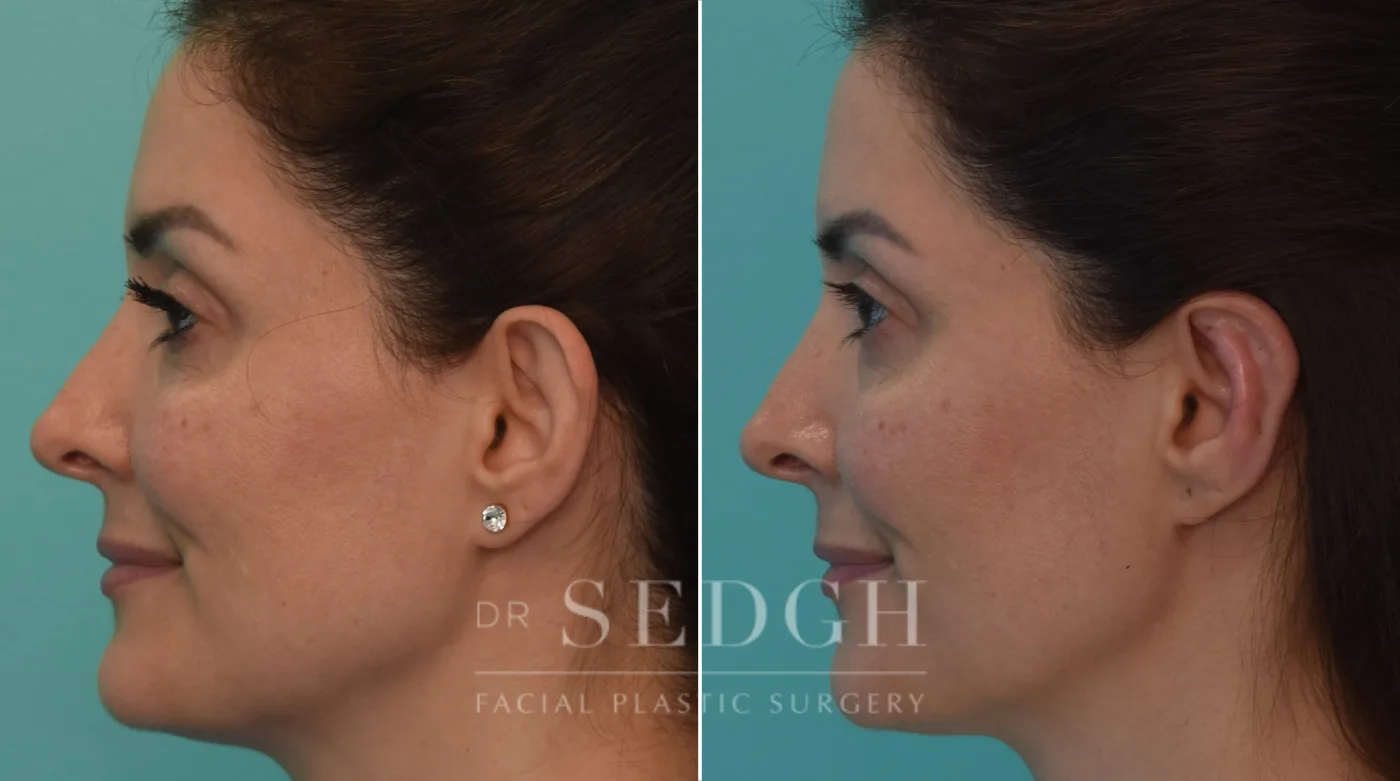 Patient 255 after Ear Pinning Surgery, view 1
