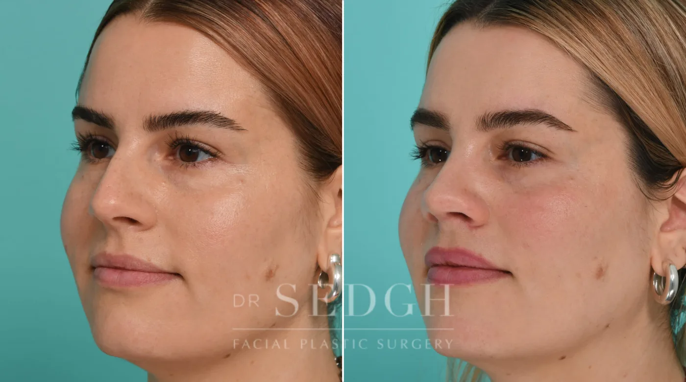 Patient 327 before Rhinoplasty, view 1