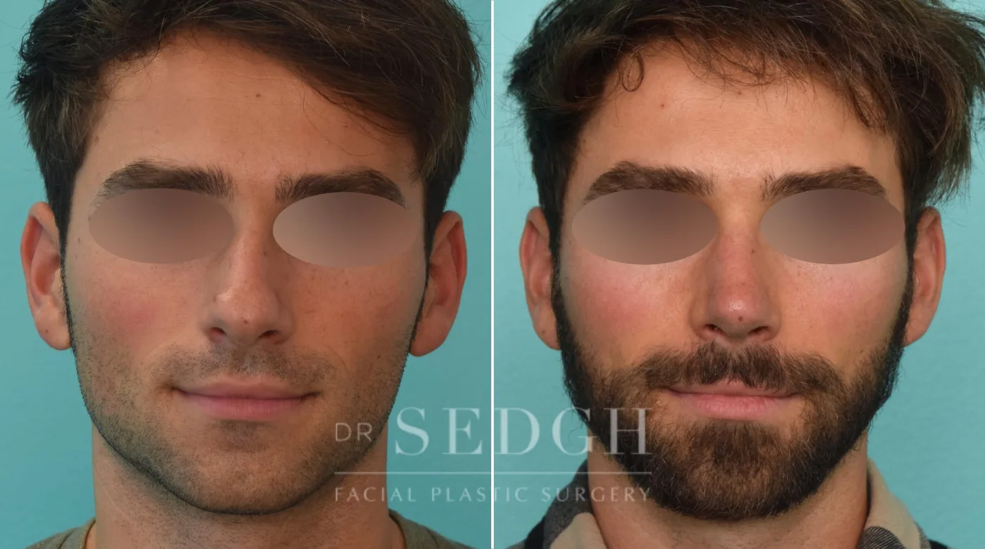 Patient 273 before Male Rhinoplasty, view 2