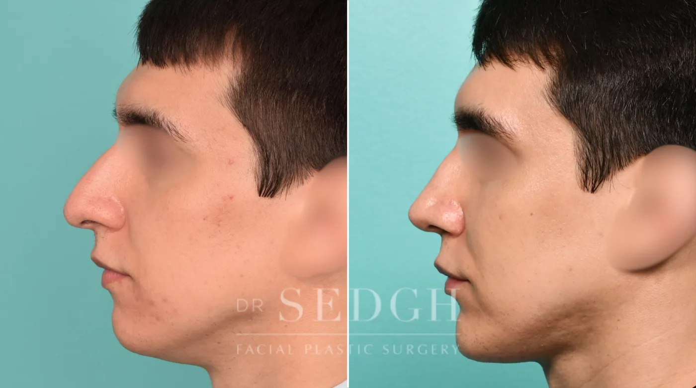 Patient 317 after Neck Liposuction, view 2