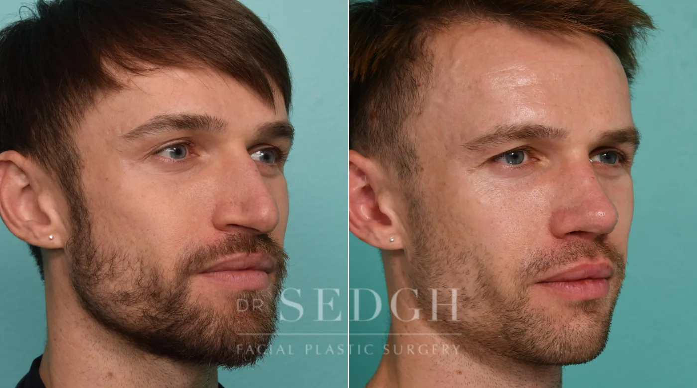 Patient 330 before Revision Rhinoplasty, view 1