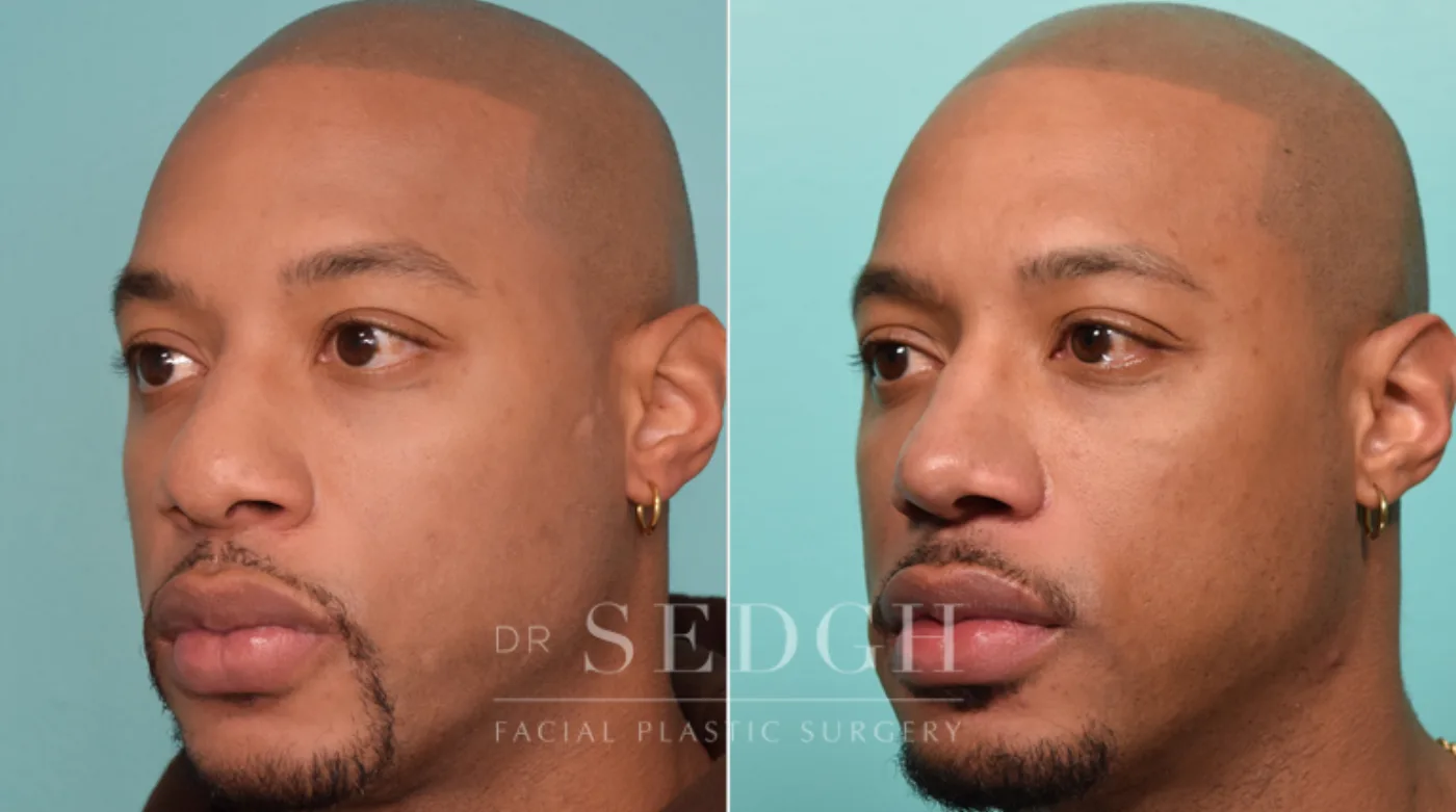 Patient 266 before African American Rhinoplasty, view 1