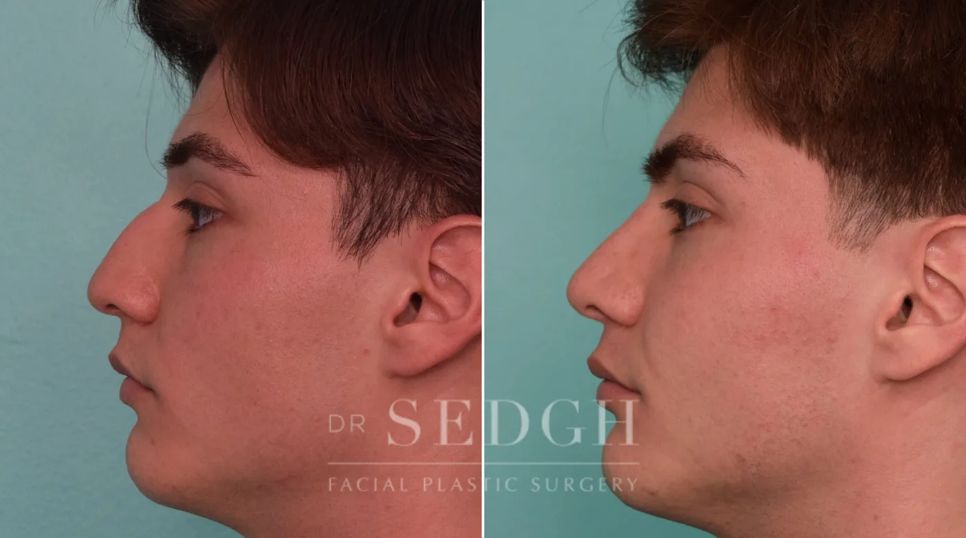 Patient 286 after Male Rhinoplasty, view 2