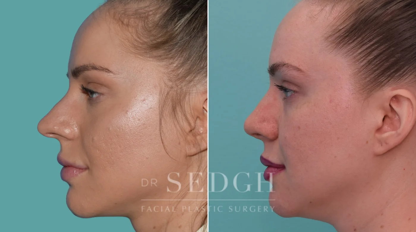 Patient 187 after Crooked Nose Surgery, view 1