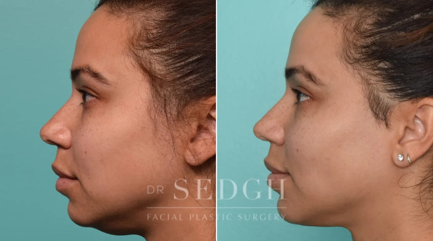 Patient 261 after Neck Liposuction, view 2