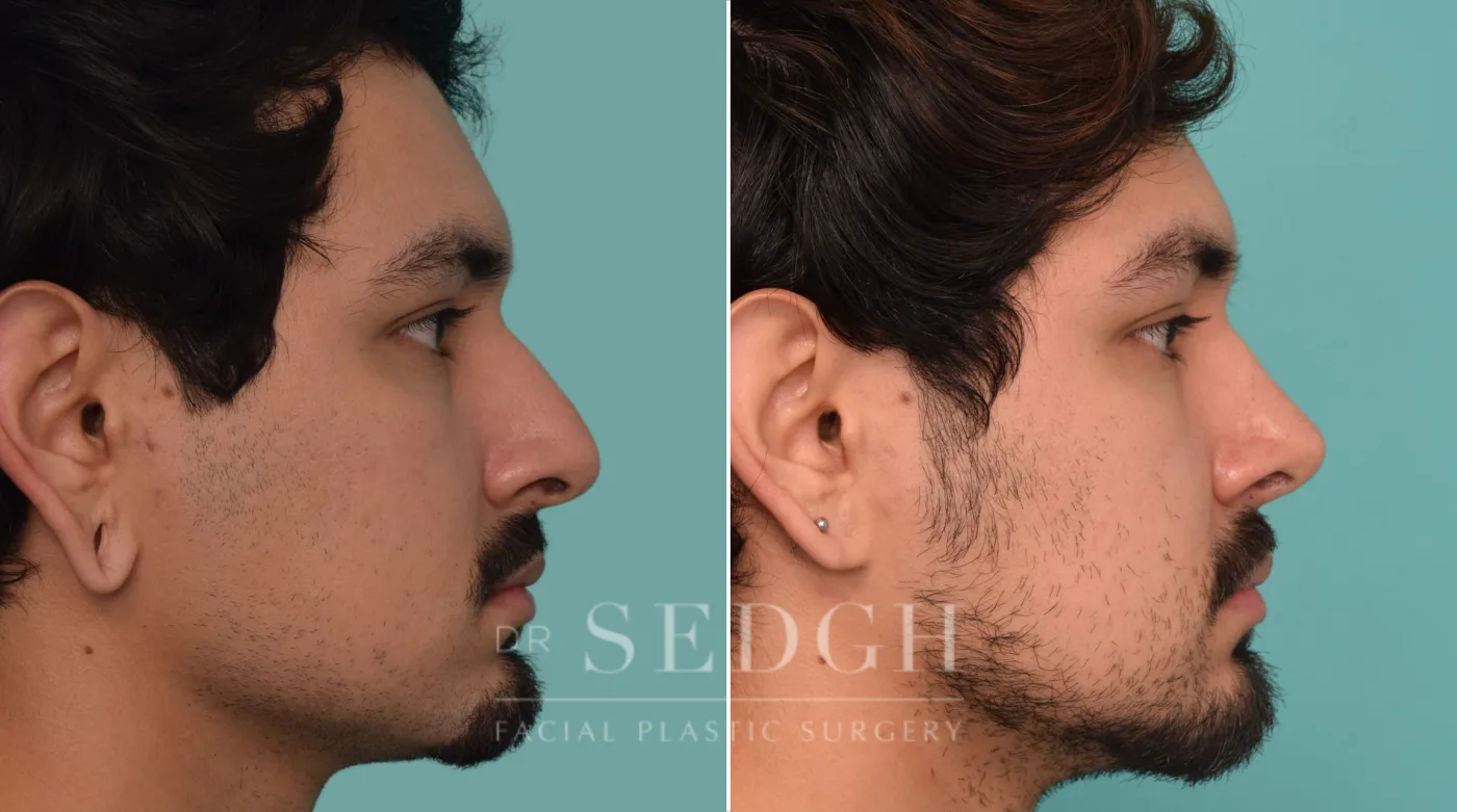 Patient 228 after Rhinoplasty, view 2