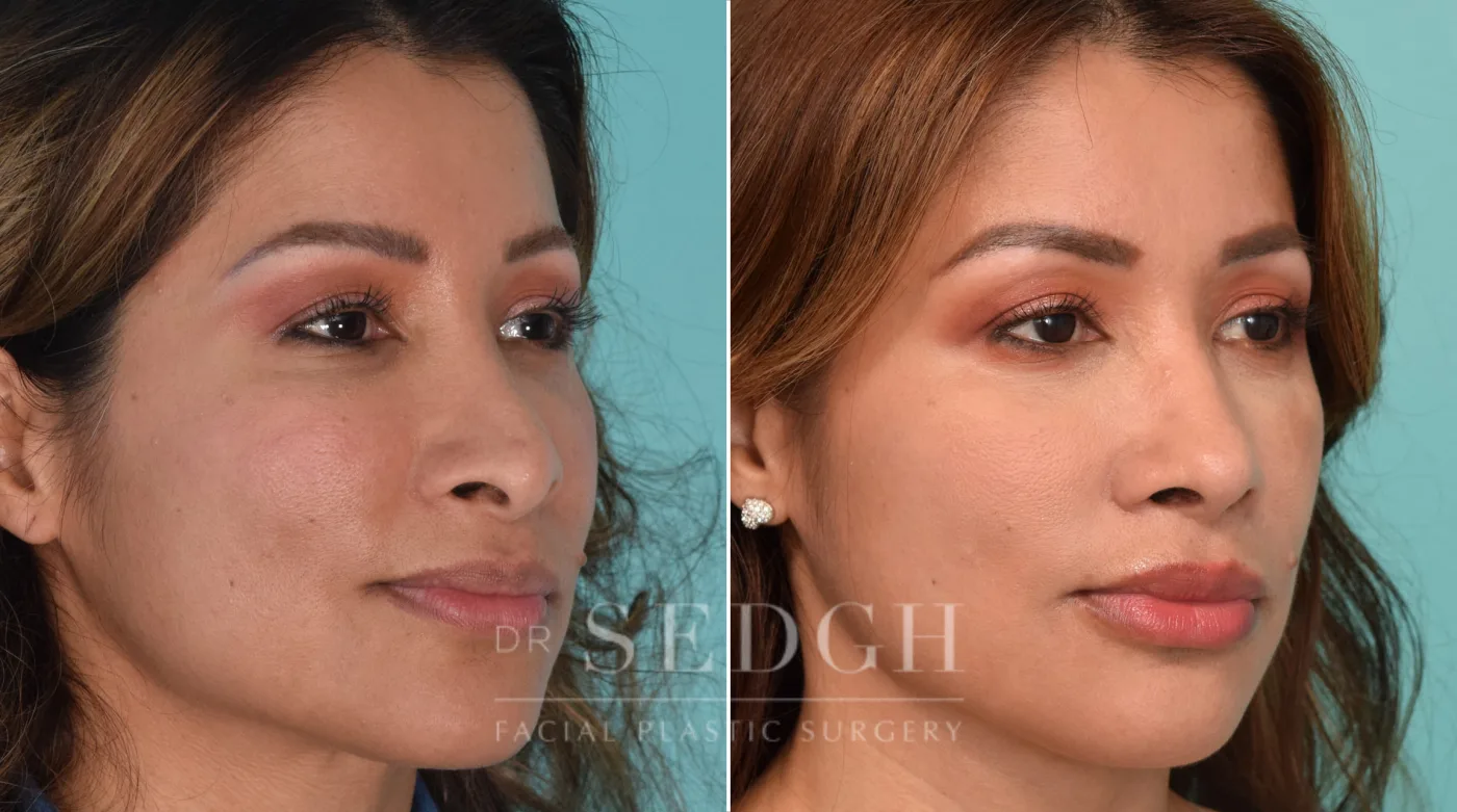 Patient 207 before Revision Rhinoplasty, view 2