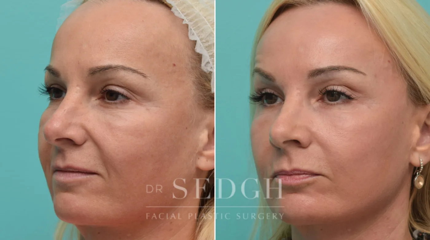 Patient 150 before Laser Skin Treatments, view 1