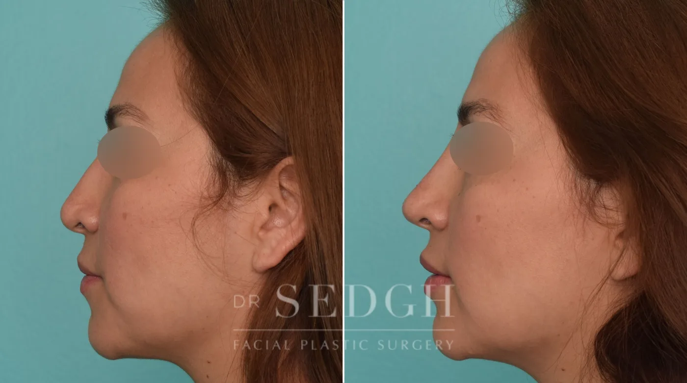 Patient 218 after Liquid Rhinoplasty, view 1