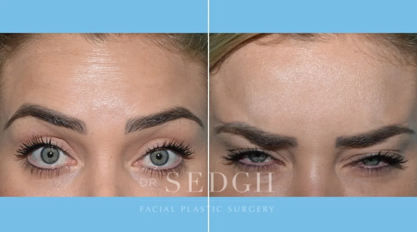 Patient 5 after Wrinkle Relaxers, view 1