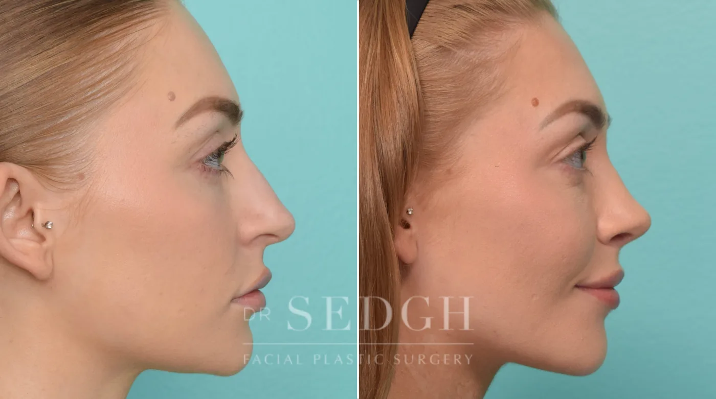 Patient 298 after Rhinoplasty, view 1