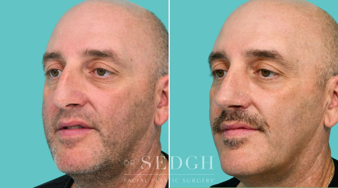 Patient 343 before Crooked Nose Surgery, view 3