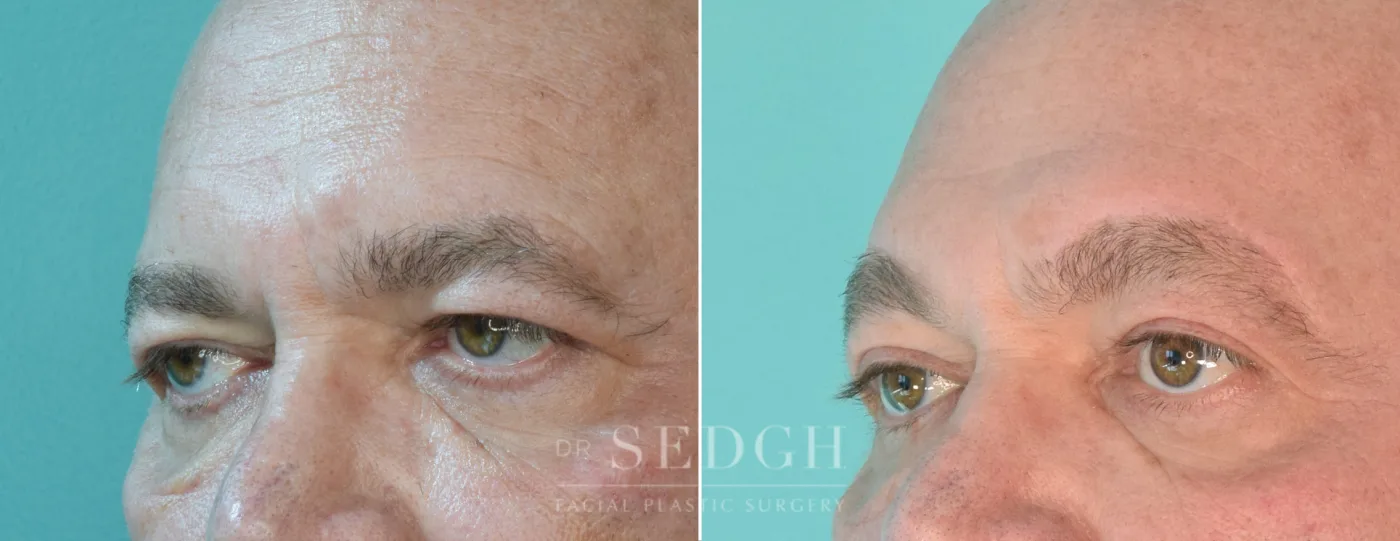Patient 205 before Upper Blepharoplasty, view 2