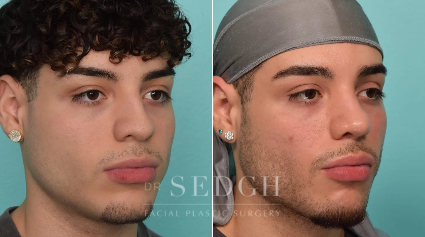 Patient 289 before Rhinoplasty, view 2