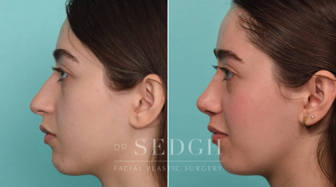 Patient 290 after Crooked Nose Surgery, view 2