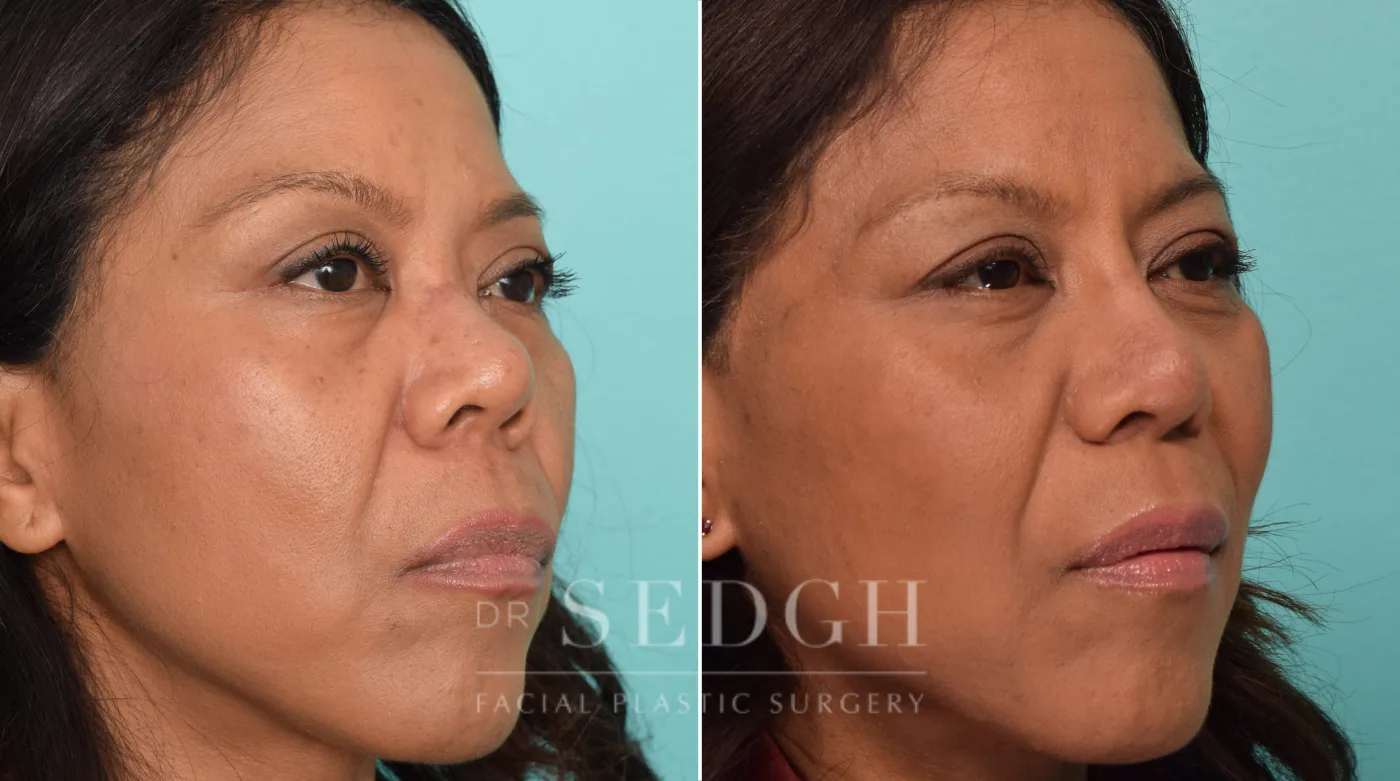 Patient 288 before Asian Rhinoplasty, view 2