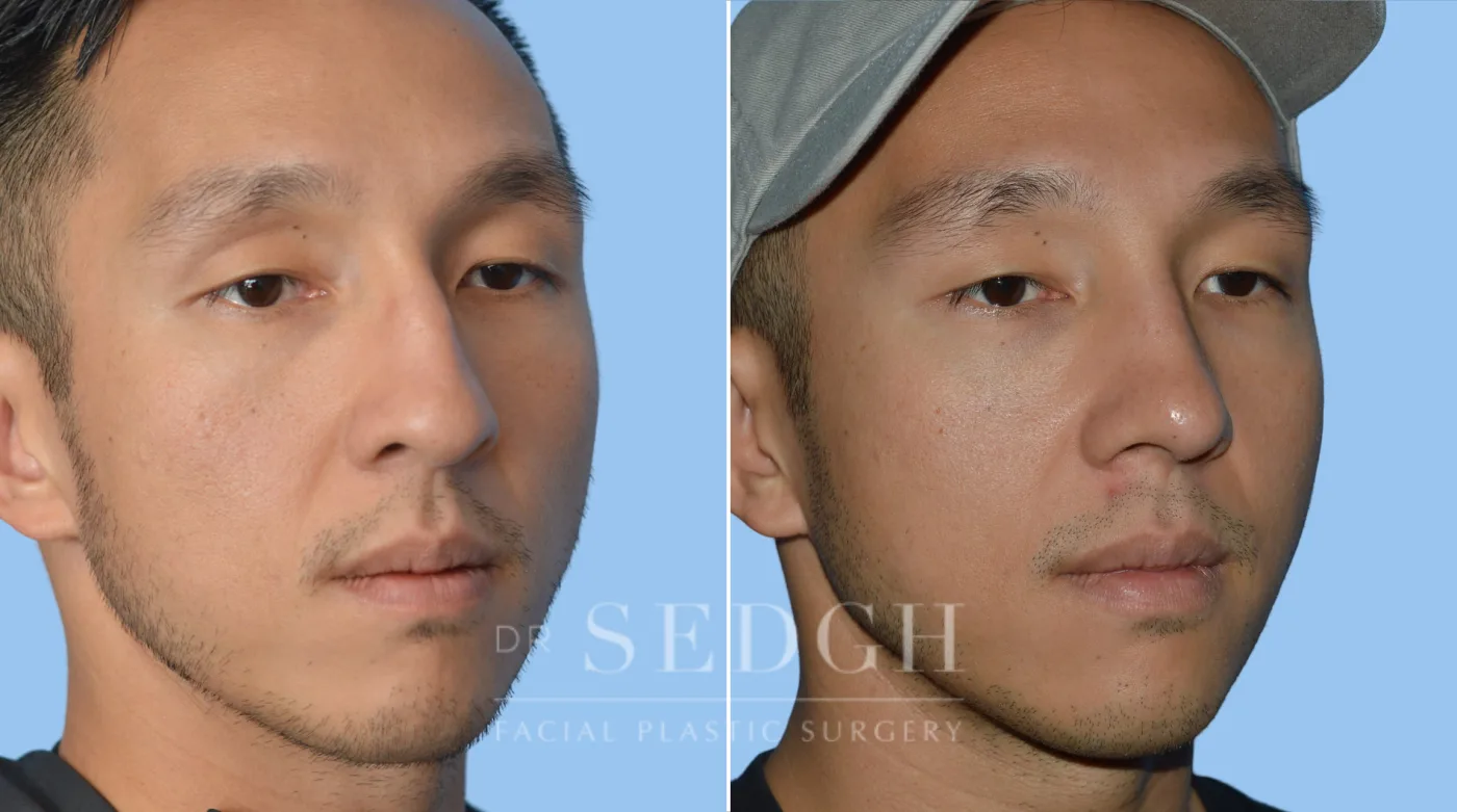 Patient 68 before Asian Rhinoplasty, view 1