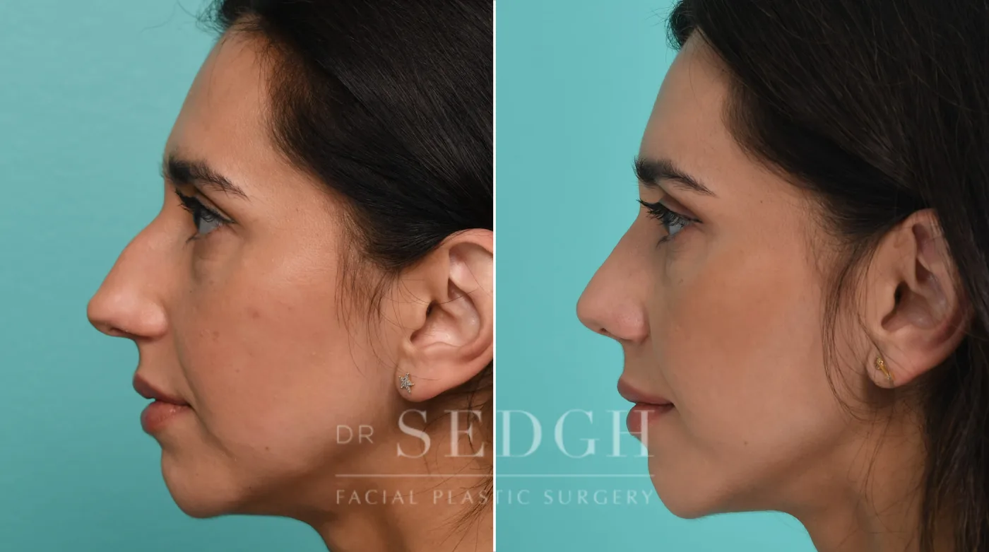 Patient 325 after Female Rhinoplasty, view 2