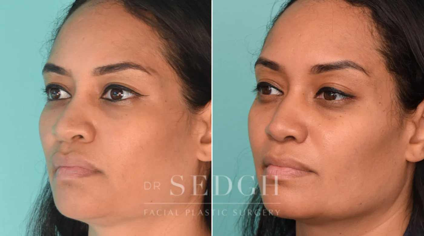 Patient 229 before Female Rhinoplasty, view 1