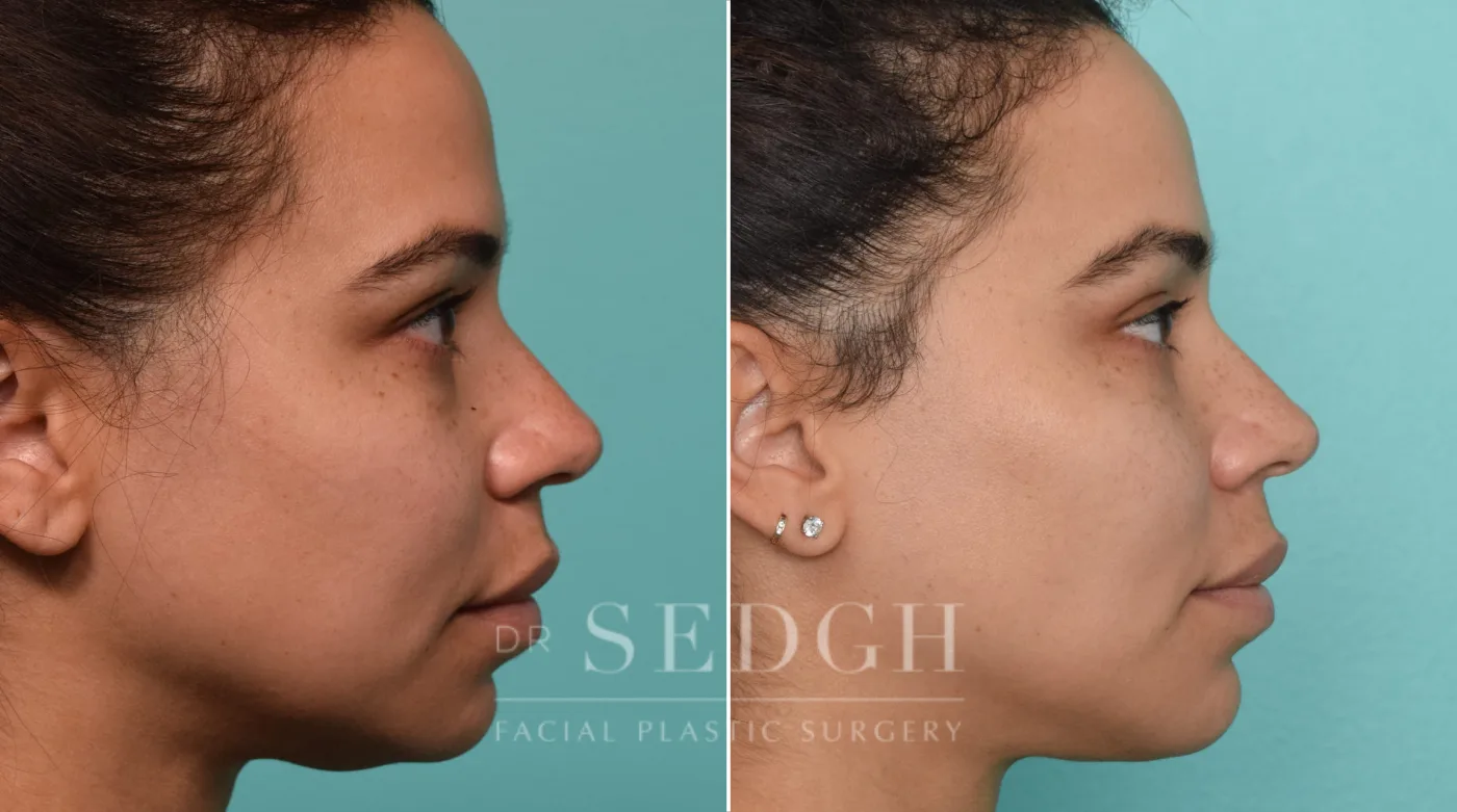 Patient 261 after Neck Liposuction, view 1