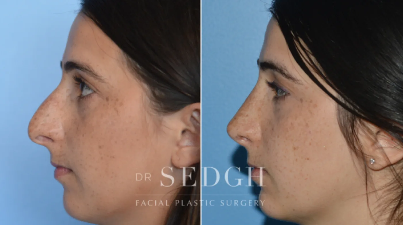 Patient 21 after Hispanic Rhinoplasty, view 1
