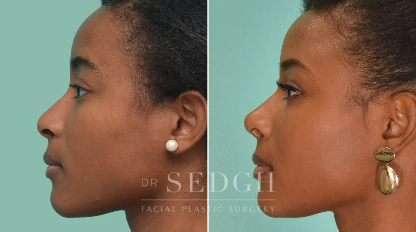 Patient 190 after Female Rhinoplasty, view 2