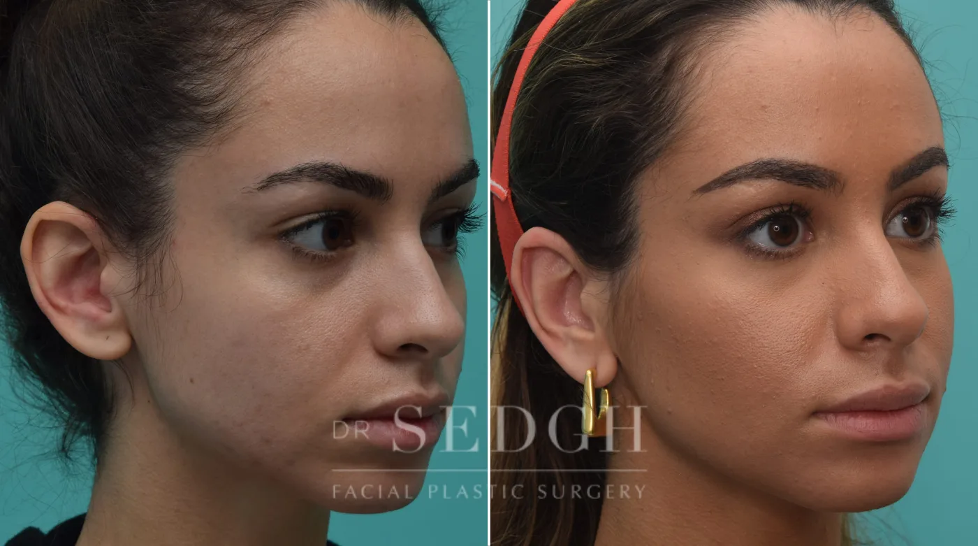 Patient 194 before Ear Pinning Surgery, view 2