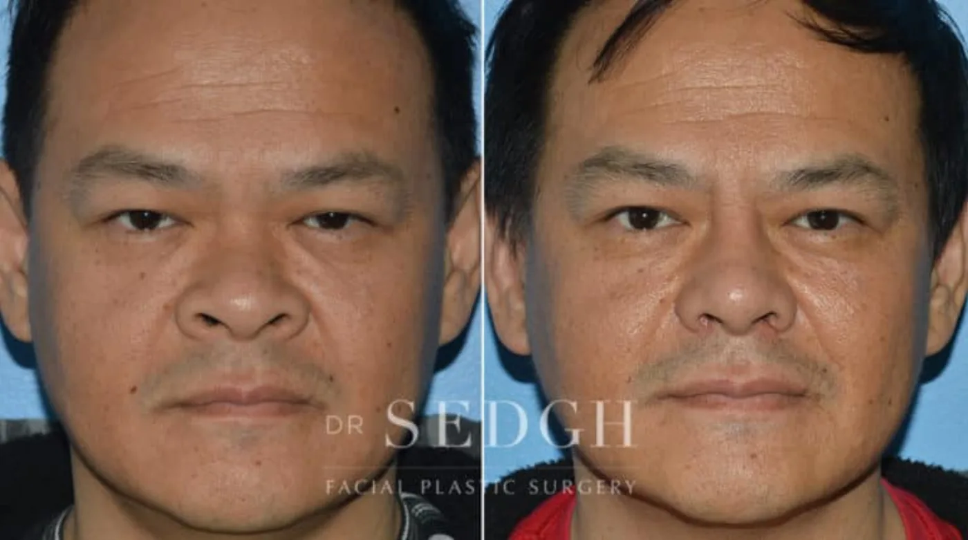 Patient 5 after Middle Eastern Rhinoplasty, view 1