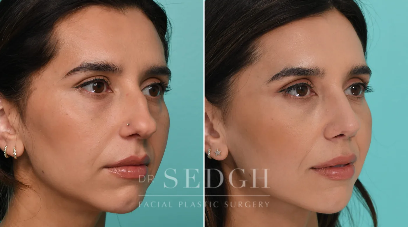 Patient 325 before Female Rhinoplasty, view 1