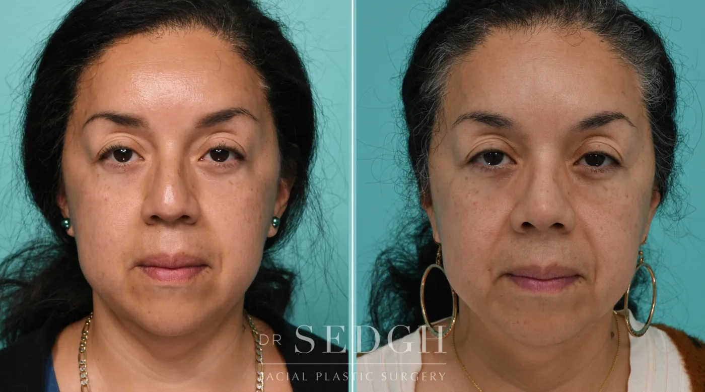 Patient 341 after Hispanic Rhinoplasty, view 3