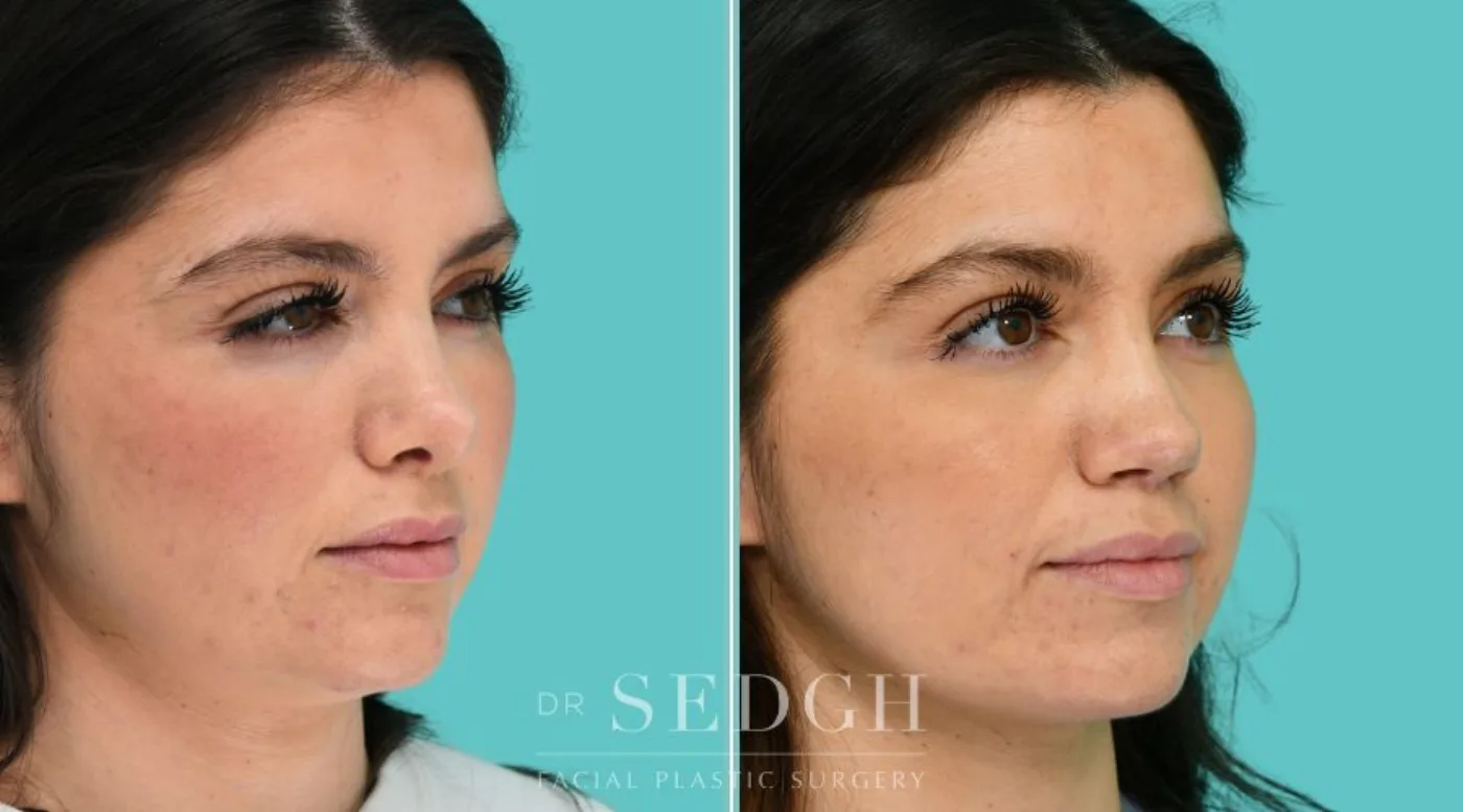 Patient 365 after Revision Rhinoplasty, view 1