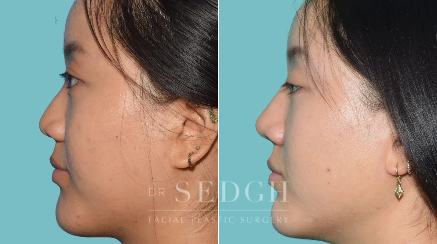 Patient 36 after Middle Eastern Rhinoplasty, view 2