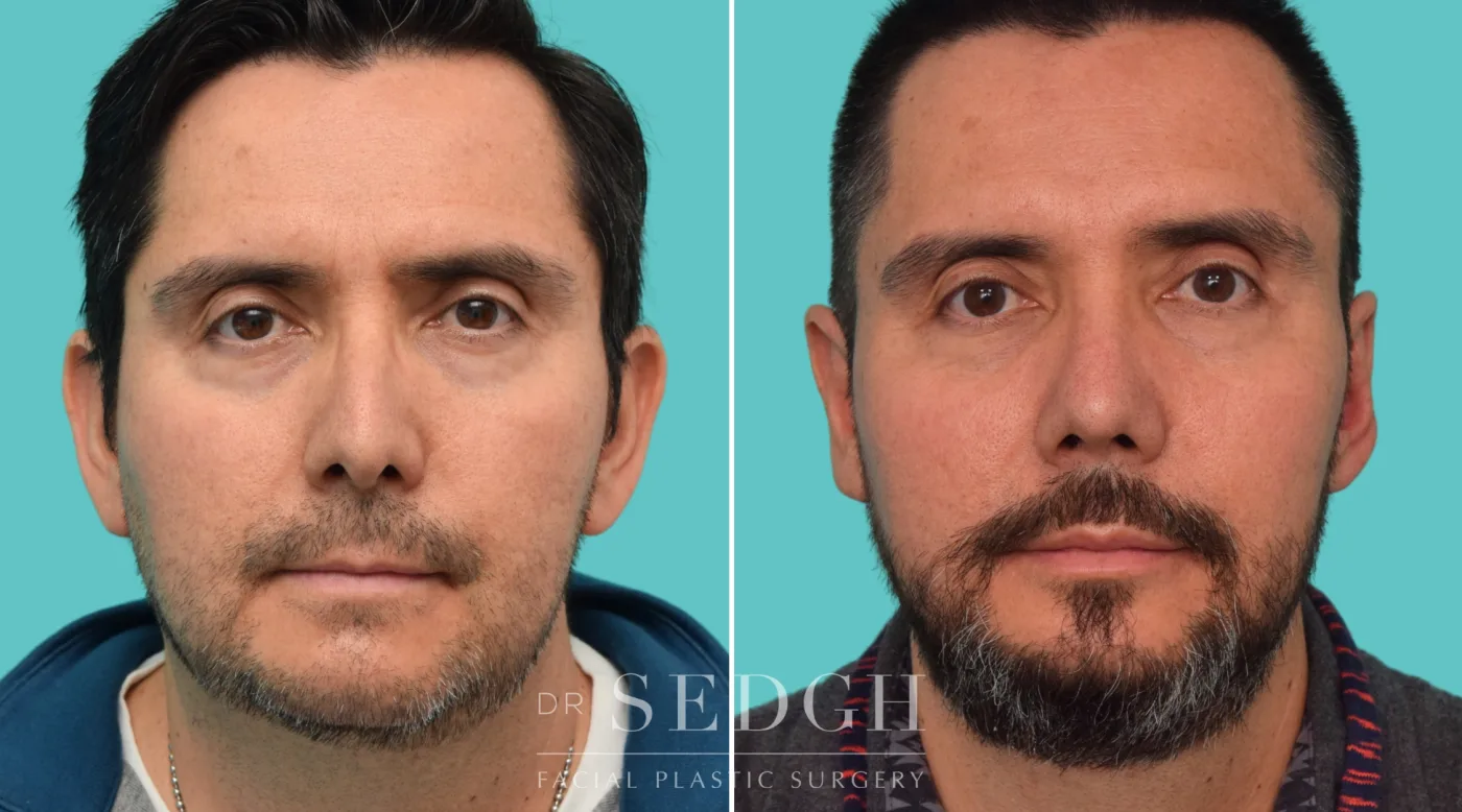 Patient 355 after Hispanic Rhinoplasty, view 1
