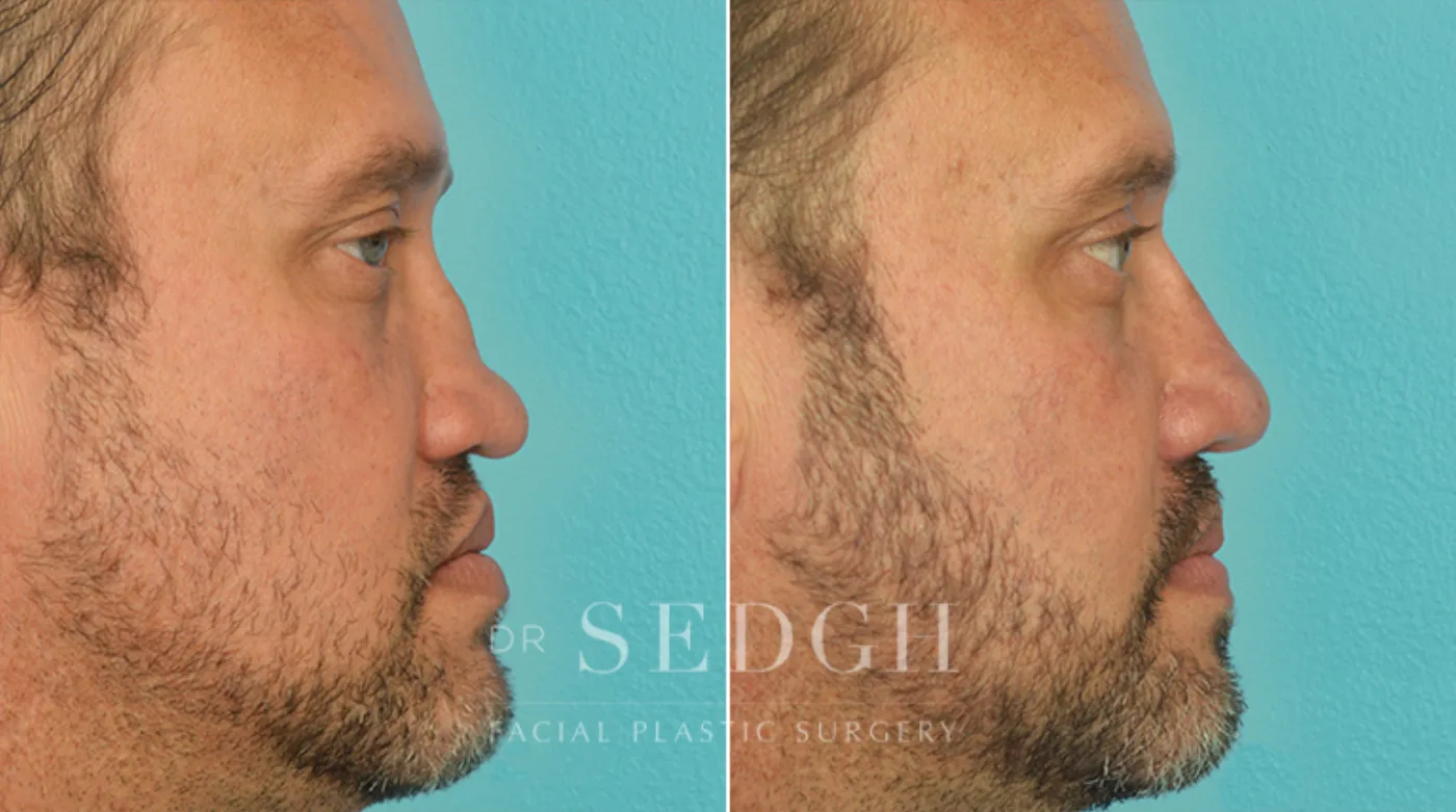 Patient 16 before Hispanic Rhinoplasty, view 1