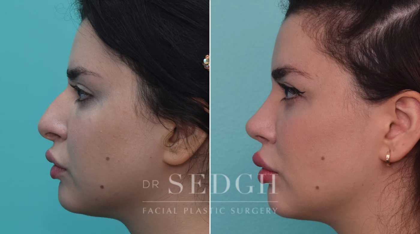 Patient 195 after Rhinoplasty, view 1