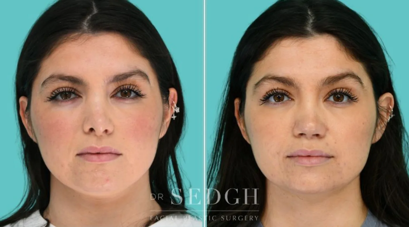 Patient 365 before Revision Rhinoplasty, view 1