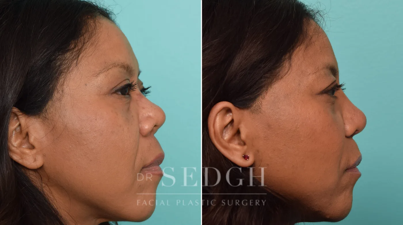 Patient 288 after Asian Rhinoplasty, view 2