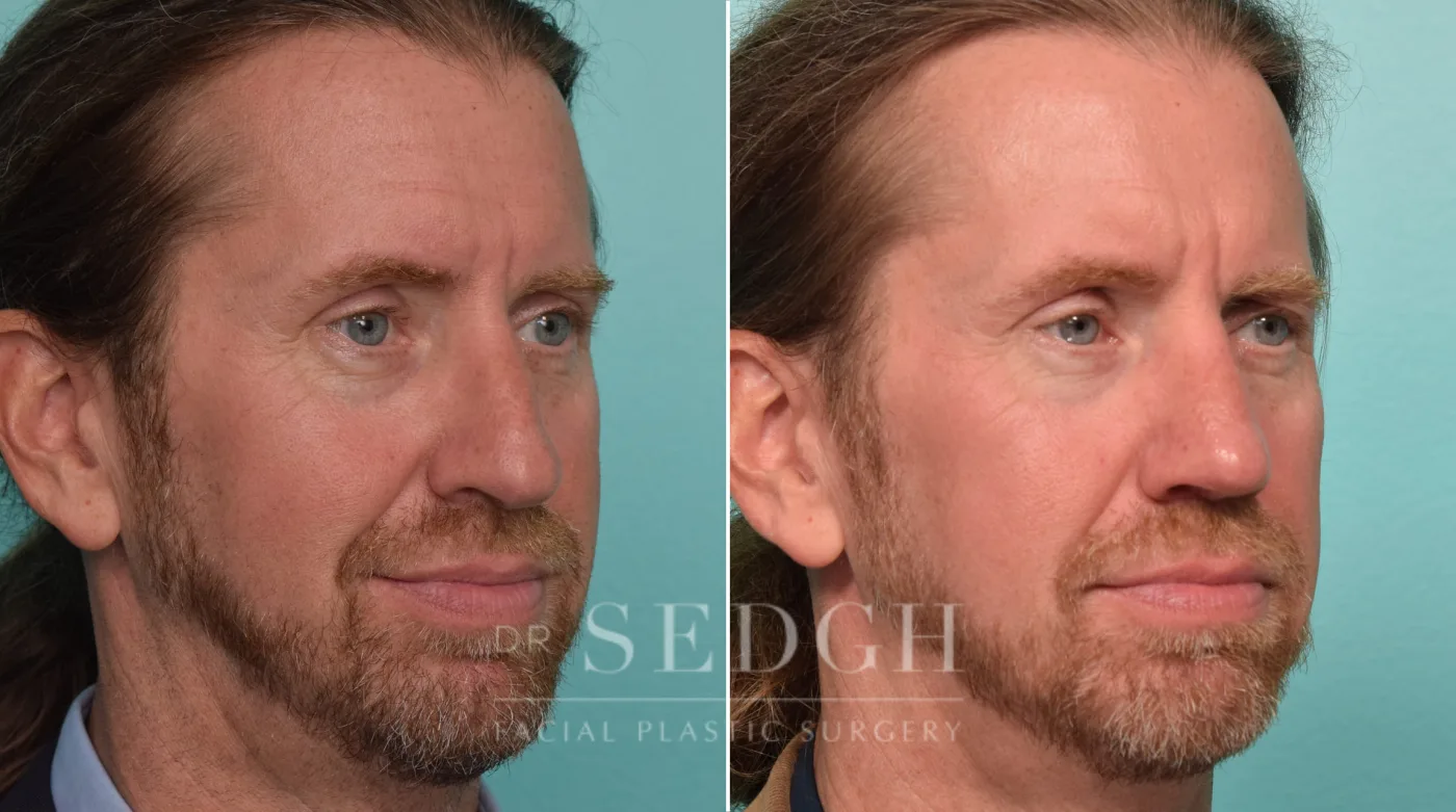 Patient 305 before Crooked Nose Surgery, view 1