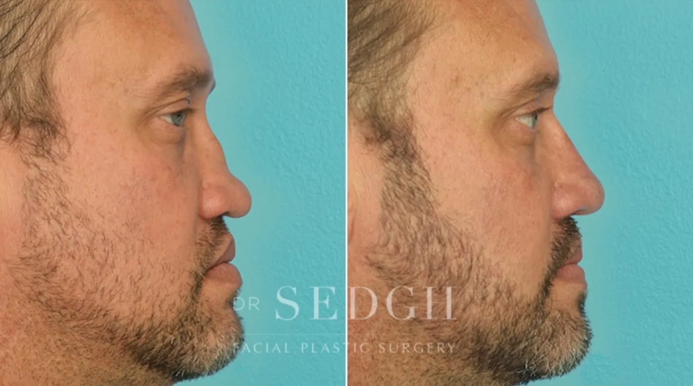 Patient 3 before Male Rhinoplasty, view 1