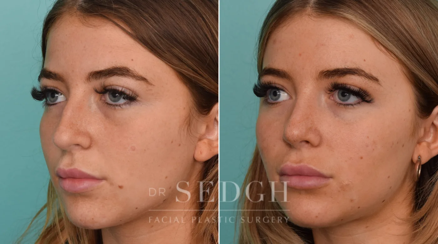 Patient 242 before Rhinoplasty, view 2