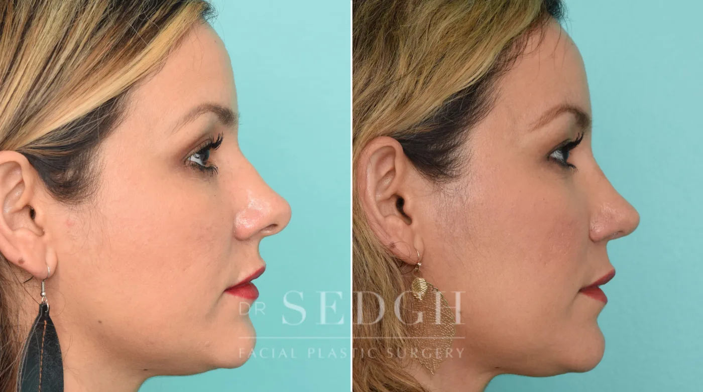Patient 260 after Rhinoplasty, view 2