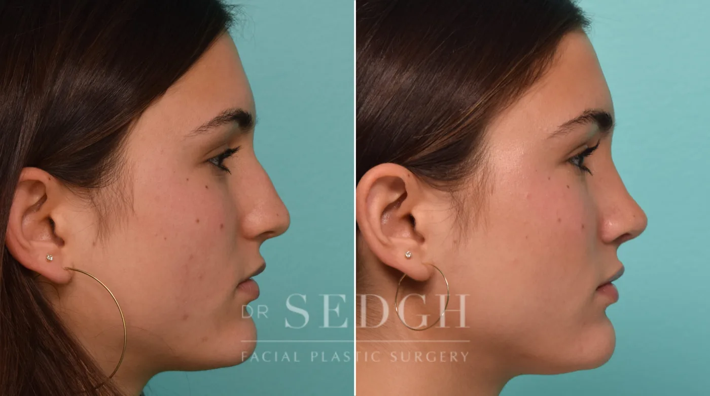 Patient 308 after Rhinoplasty, view 2