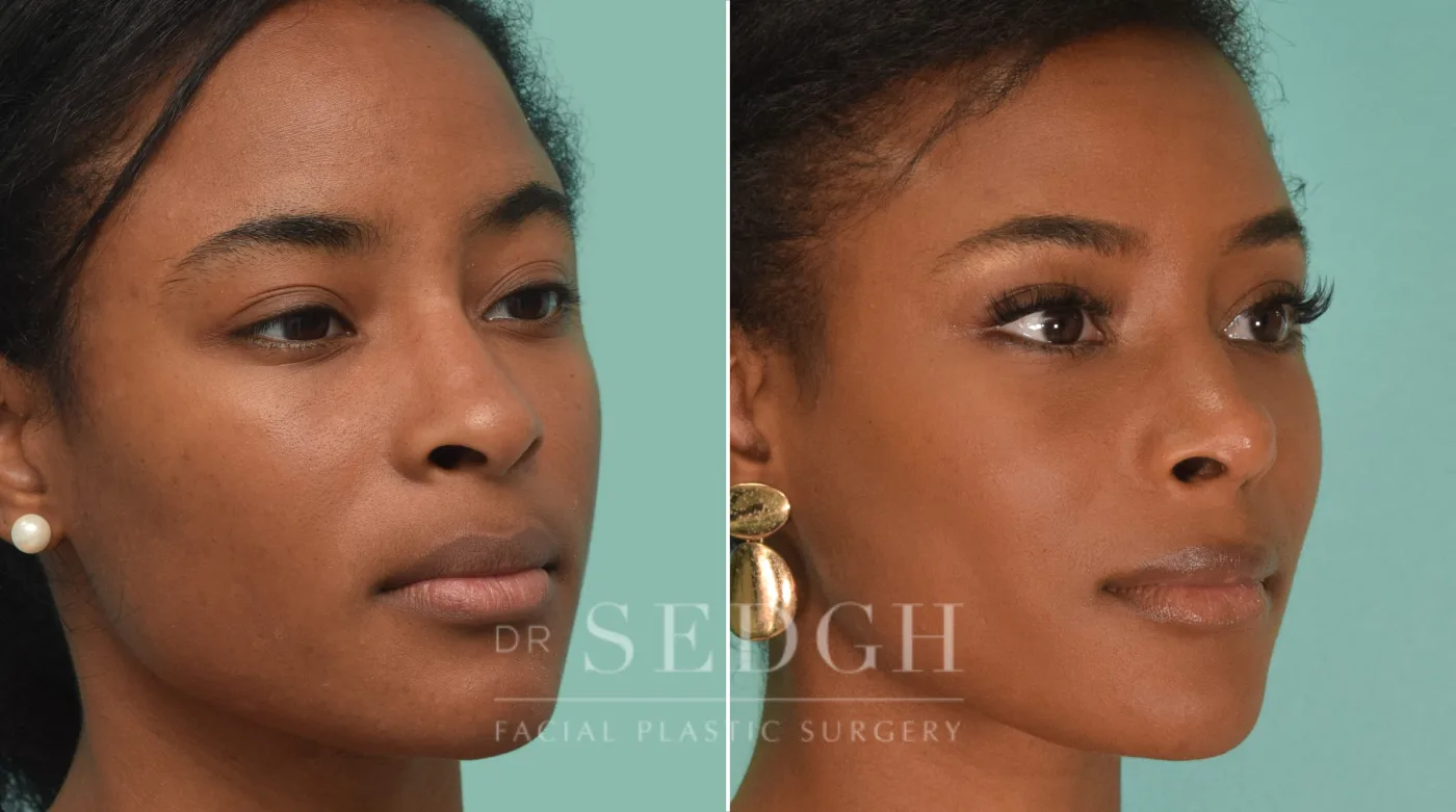 Patient 190 before Female Rhinoplasty, view 1